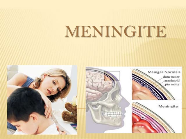 Meningite