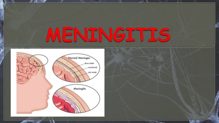 Meningitis