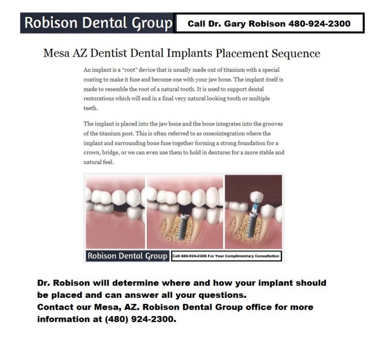 Mesa AZ Dental Implant Placement Procedure By Dr.Gary Robison