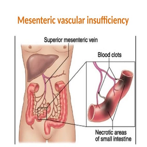 Chronic Mesenteric Ischemia | PPTX