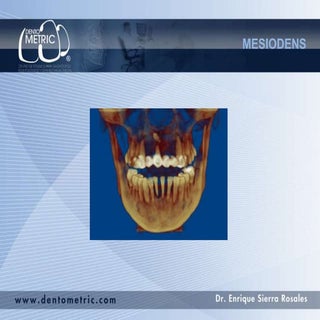 Mesiodens