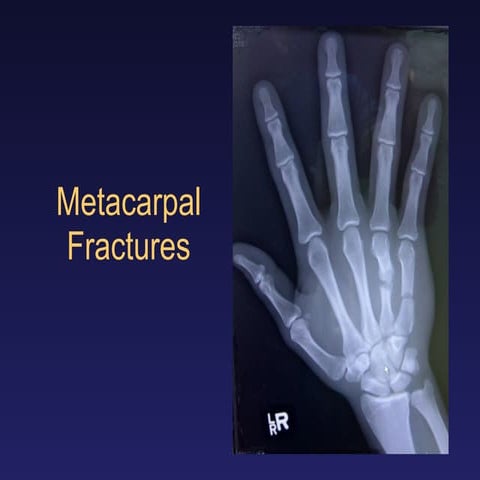 Metacarpal fractures