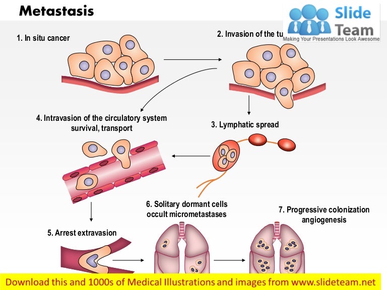 Metastasis