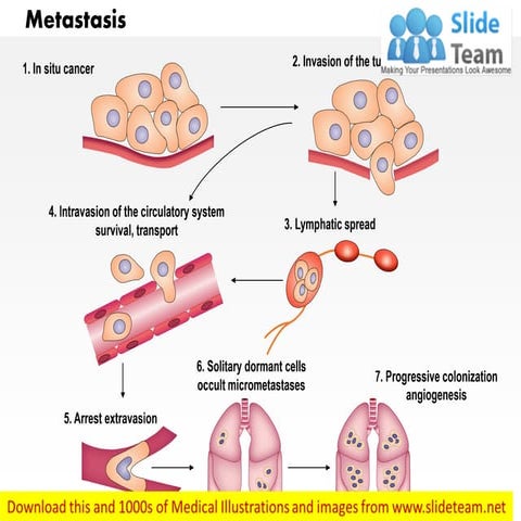 Metastasis medical images for power point