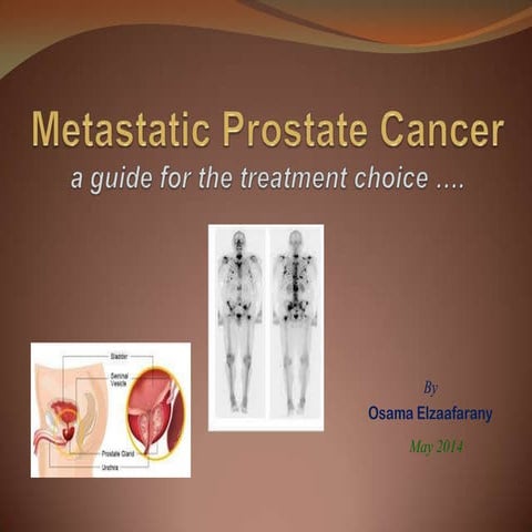 Metastatic prostate cancer.. a guide for treatment choice