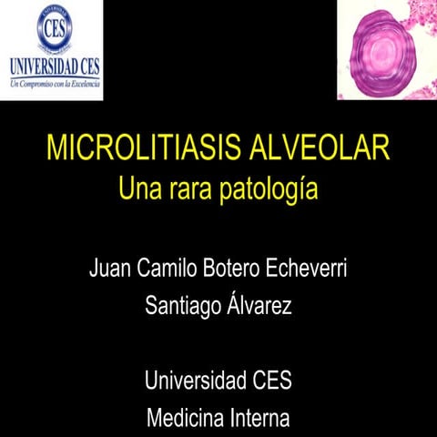 Microlitiasis alveolar | PPT