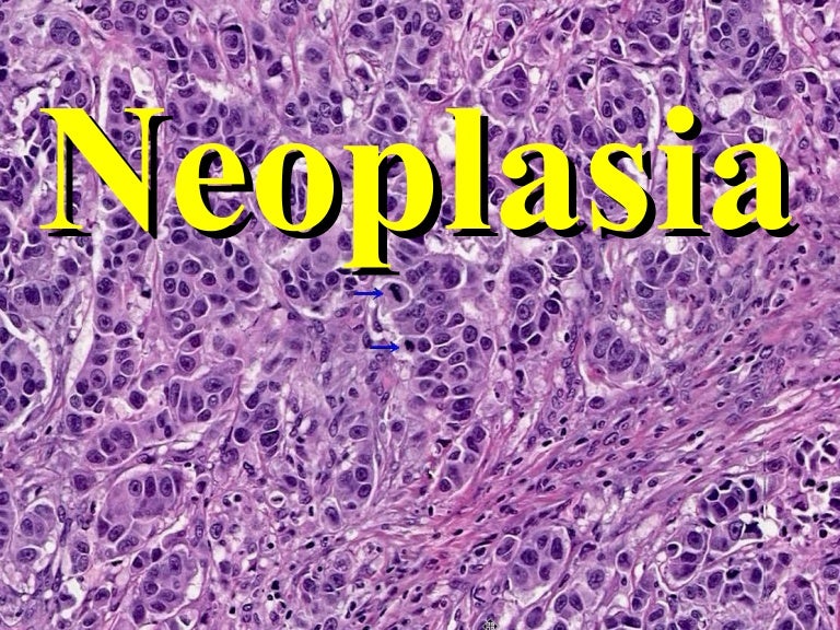 neoplasia intraepitelial prostatica pathology outlines neoplasia intraepitelial prostatica pathology outlines