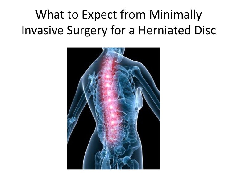 Minimally Invasive Surgery for a Herniated Disc