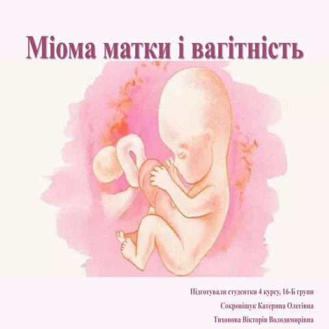 Міома | PPT