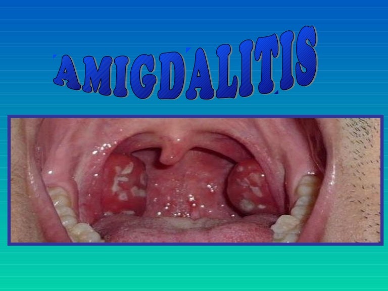 AMIGDALITIS