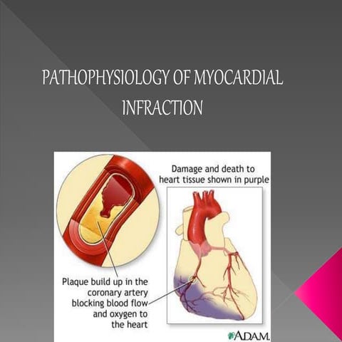 Myocardial infartion pathophysiology