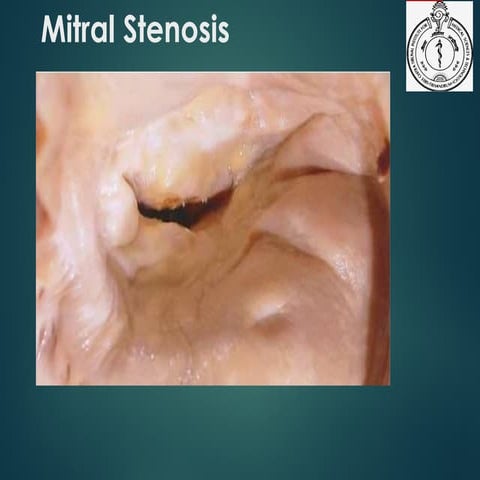Mitral Stenosis- Pathophysiology, diagnosis and management