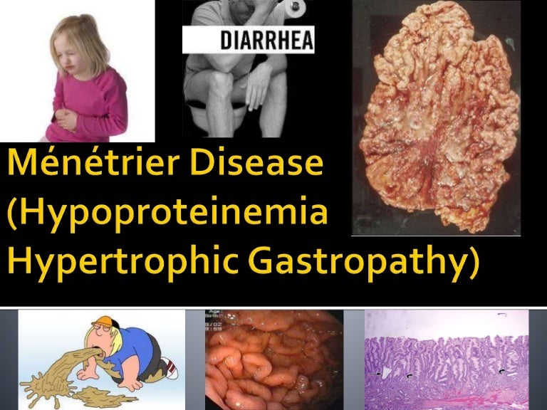 Ménétrier disease (final)