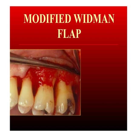 Modified widman flap