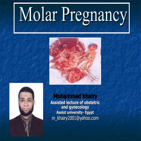 Molar pregnancy | PPT