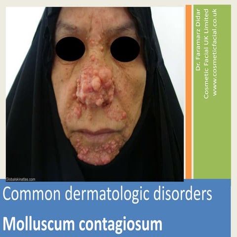  Molluscum-contagiosum cfuk