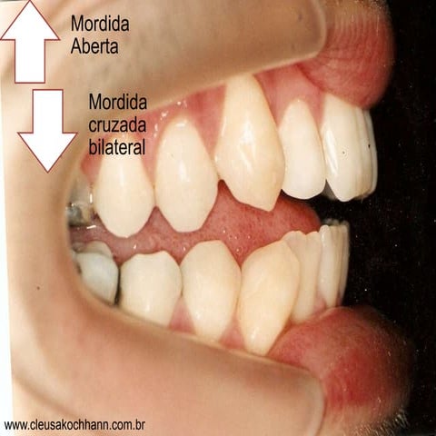 Mordida Aberta   Mordida Cruzada