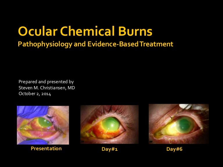 Ocular Chemical Burns Pathophysiology and EvidenceBased Treatment