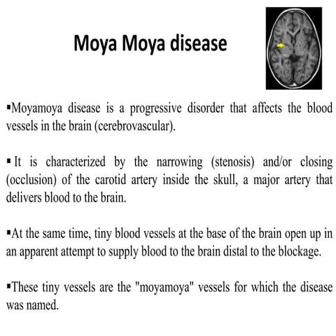 Moya moya disease