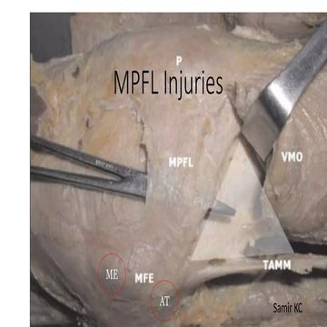 Medial patellofemoral ligament injuries and management