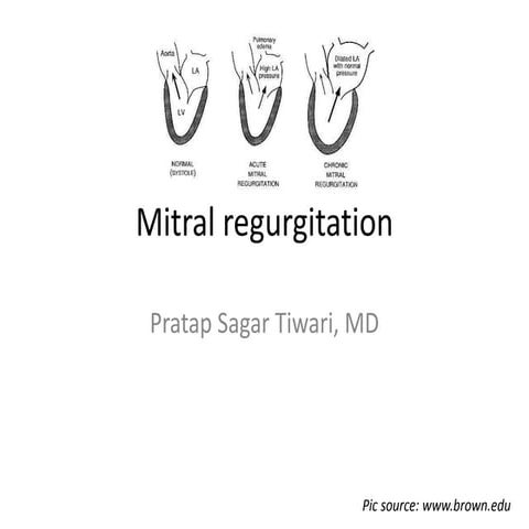 Mitral regurgitation