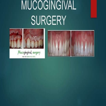 Mucogingival surgery in periodontics