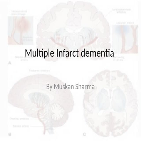 Comprehensive Overview of Multi-Infarct Dementia: Causes, Types, and ...