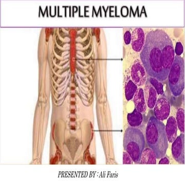 Multiple myeloma