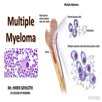 Multiple myeloma