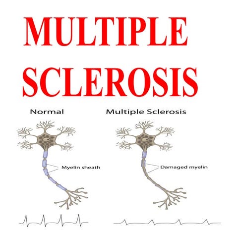 multiplesclerosis-180211164508.pp studenttx