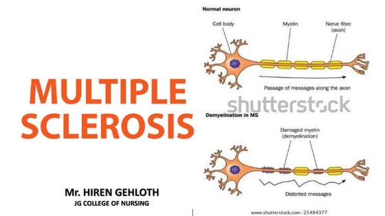 Multiple sclerosis | PPTX