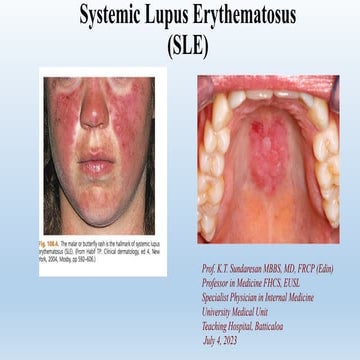 pathogenesis and pathophysiology of SLE | PPT