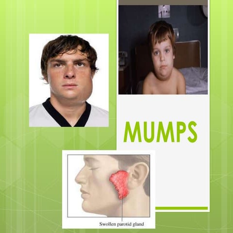 Mumps | PPTX