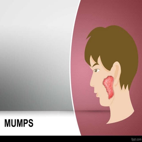 Mumps | PPTX