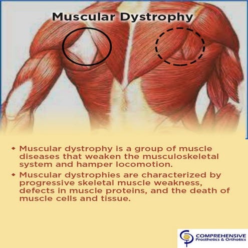 Muscular Dystrophy