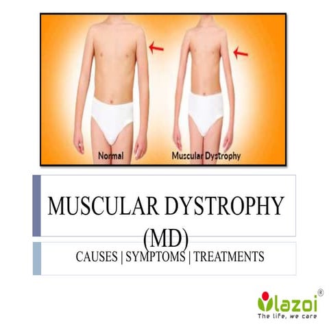 Muscular dystrophy:  Group of more than 30 inherited diseases.