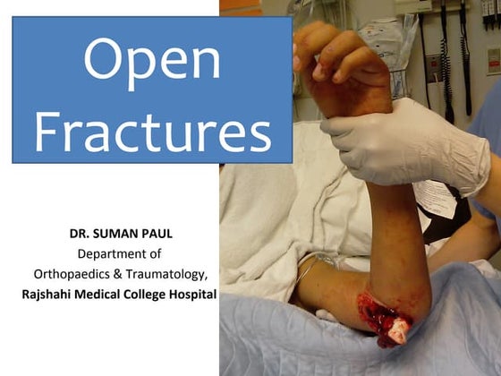 Open fracture types and management .pptx
