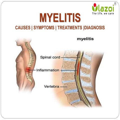 Myelitis