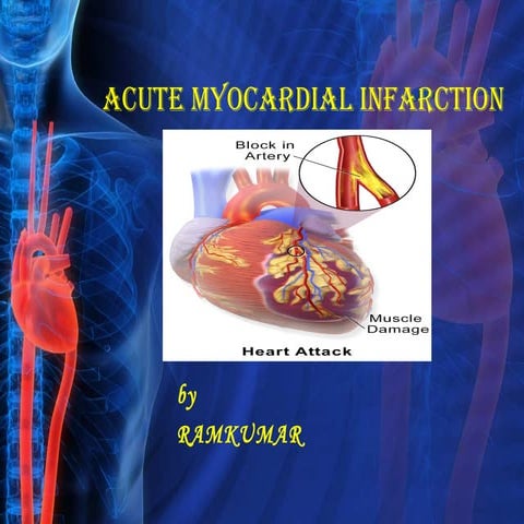 Myocardial infarction