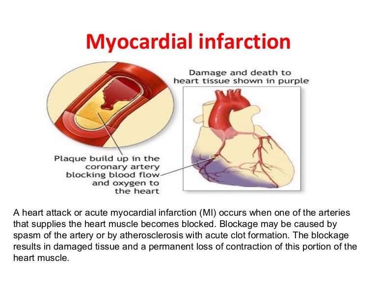 What Are The Features Of Myocardial Infarction? – EIYUB