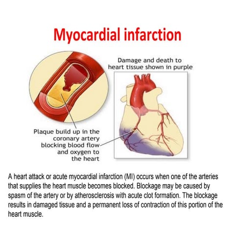 Myocardial infarction