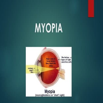 Comprehensive Overview of Myopia: Types, Causes, and Treatments | PPTX