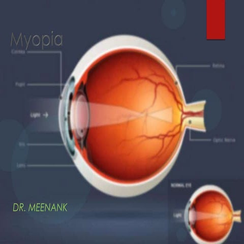 Myopia refractive error-M.B
