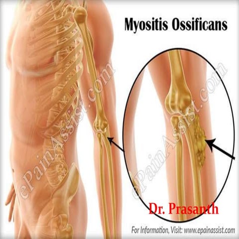 Myositis ossificans