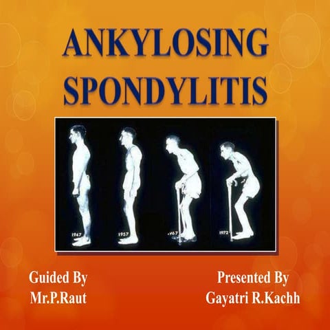 Ankylosing Spondylitis