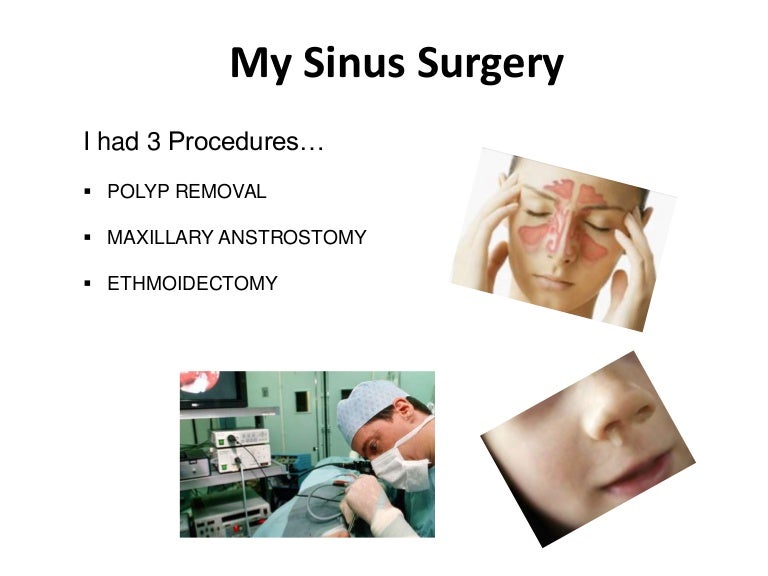 My sinus surgery