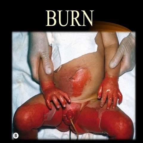 BURN - Presented By Mohammed Haroon Rashid 