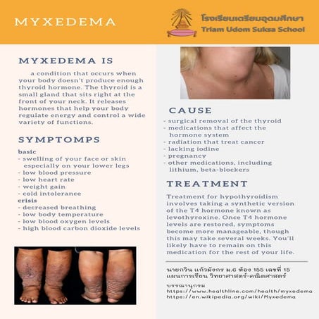 Myxedema 