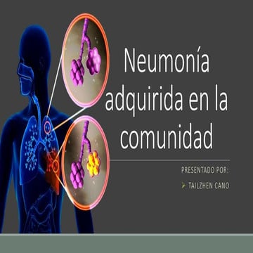 Neumonía adquirida en la comunidad