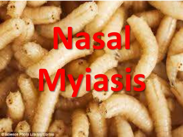 miasis nasal